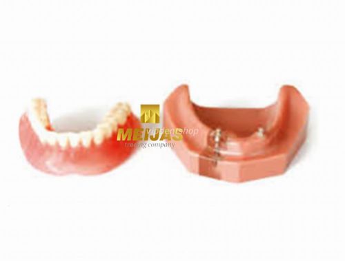 1*XINGXING Dental Overdenture Teeth Model Inferior With 2 Implants 6007 Original