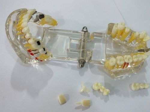 Dental Teeth Implant all Disease REMOVABLE Implant Bridge Crown Model Acrylic