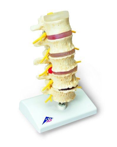 3B Scientific A795 Stages of Disc Prolapse and Vertebral Degeneration Model,