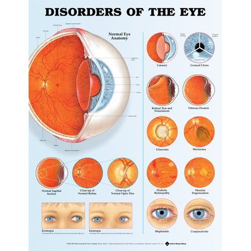 NEW Disorders of the Eye Anatomical Chart