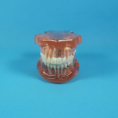 2x hs dental tooth study implant restoration education teaching display clear for sale