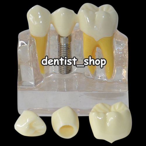 4:1 Transparent Dental Implant Demonstration Model Implant Communication Model
