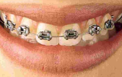 10 cases XB Roth 5x5 direct bond Orthodontic brackets, 022&#034; slot hooks on 3,4,5