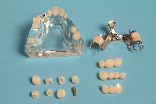Dental Demonstration Demo Model Implant abutment, fixed and removable prosthesis