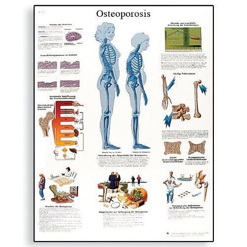 3B Scientific VR1121L Glossy Laminated Paper Osteoporosis Anatomical Chart  Post