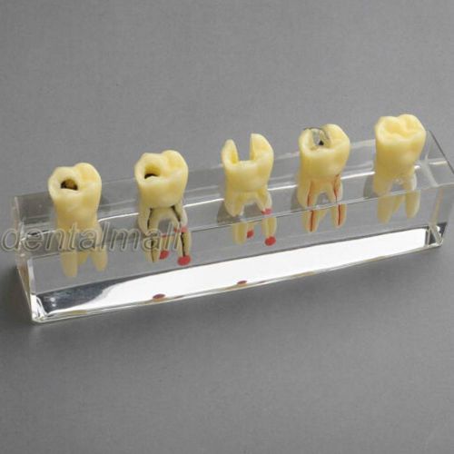 Dentalmall Dental Model #4012 01 - Root Treatment Model