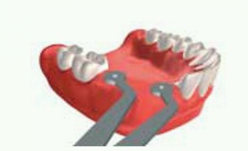 Dental implant diameter guide Nobel Biocare Implant Indicators