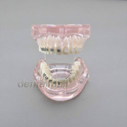 Dentalmall Dental Model #3009 01 - Orthodontic Model with Different Brackets