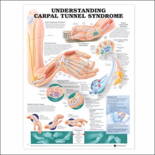 Anatomical Chart Company Carpal Tunnel Syndrome Chart 9781587793226 USG
