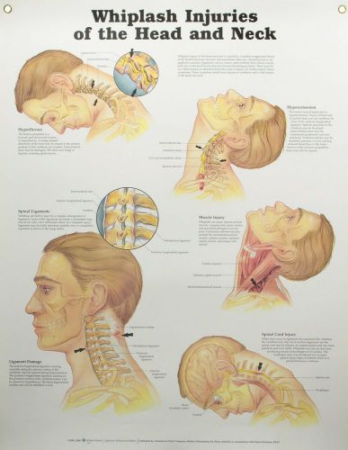 NEW Whiplash Injuries of the Head and Neck Anatomical Chart