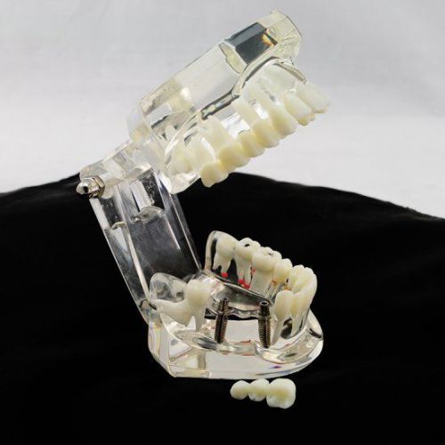 1pc Dental Implant Disease Teeth Model with Restoration &amp; Bridge Tooth