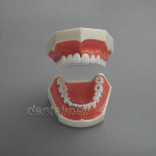 Dentalmall Dental Model #4003 01 - Periodontosis Model