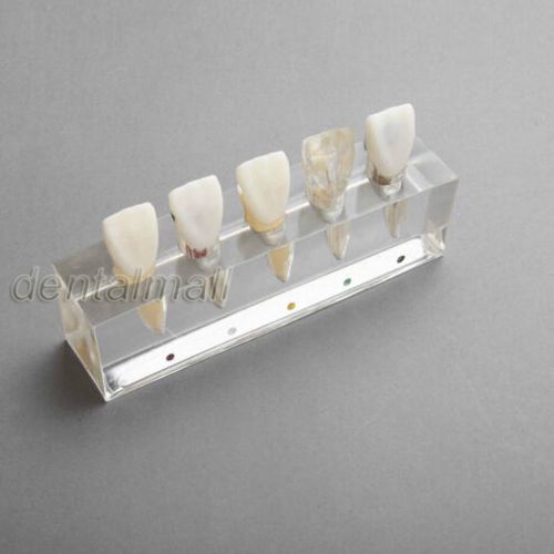 Dentalmall Dental 4008 01-5-Stage Upper Incisors Endodontic Treatment Model