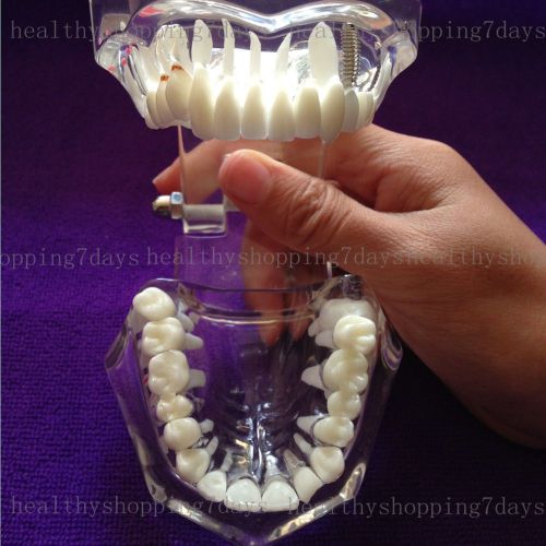 2015 new year sale!Dental Implant Teeth restoration demonstration teaching model