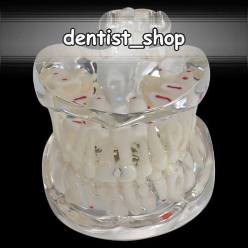 Transparent Mixed Dentition Teeth Model Typodont with Decay for Children