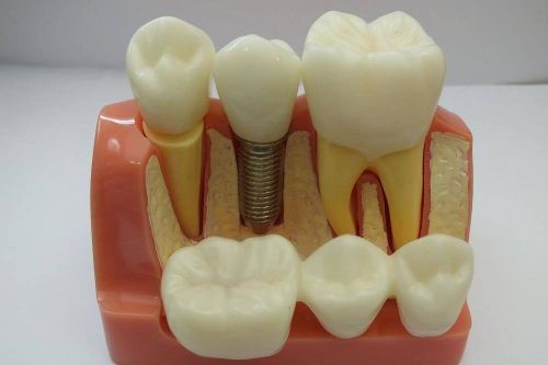 Dental Implant Model With Breedge