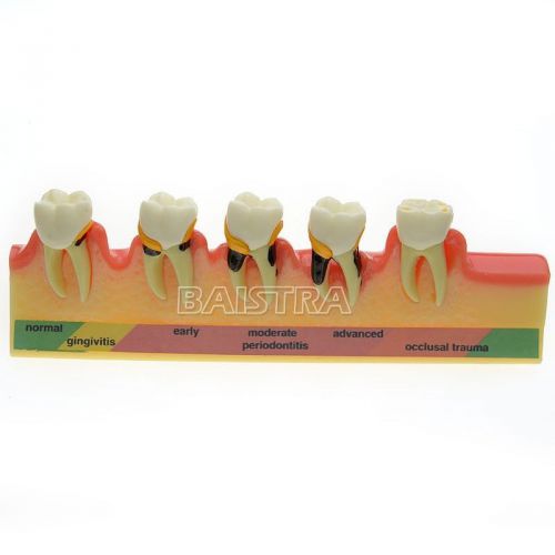 Dental Periodontal Disease Assort Typodont Tooth Teeth Study Teaching Model 4010