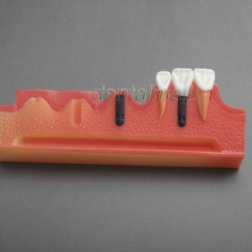 Dentalmall Dental Model #2018 01 - Implant Demonstration Model