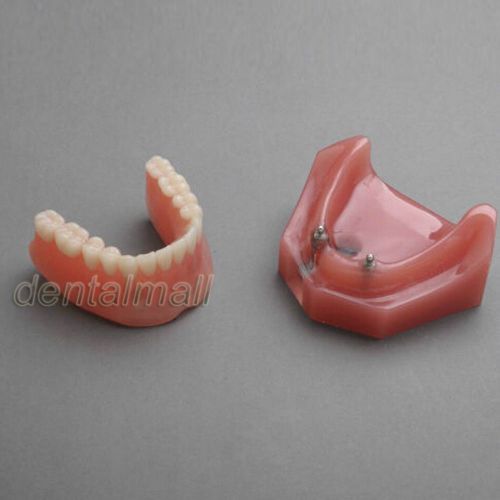 Dentalmall Dental Model #6007 01 - Overdenture Inferior with 2 Implant Demo