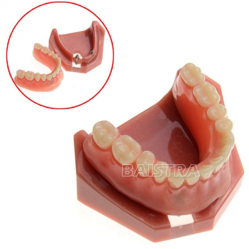 New Dental Teeth Study Teach Model Implant Repair Model #6007