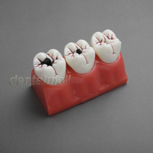 Dentalmall Dental Model #4013 01 - Caries Progression Model