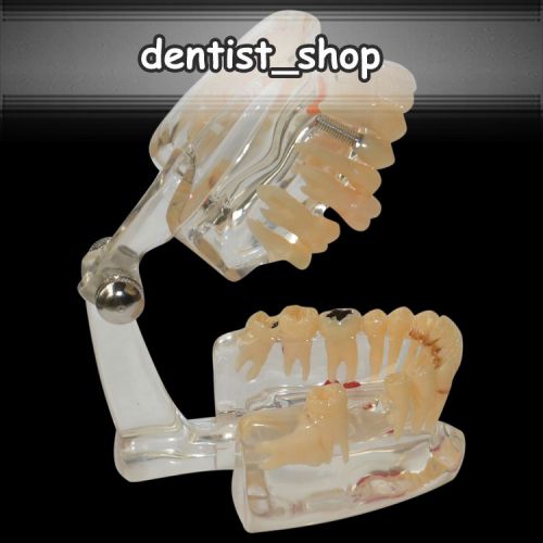 Transparent Adult Pathology Teeth Model with Full Implant for Oral Demonstration