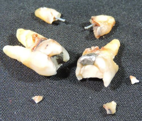 Human Teeth - #2 &amp; #3 - Roots, Root Canal Remnants, For Medical Study