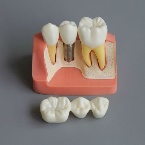 Dental Implant Study Analysis Crown Bridge Demonstration Teeth Model Dentist