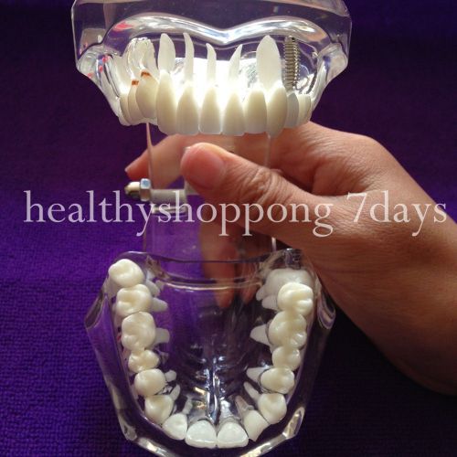 Promotion Dental Teeth Study Model Classic Implant Model wit Restoration Dentist