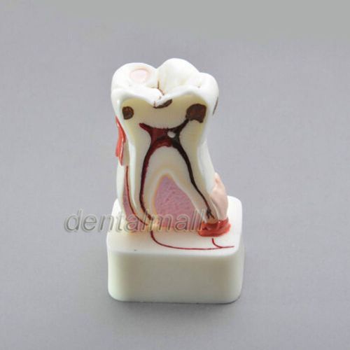 Dentalmall Dental Model #4044 01 (#4015 02)- 4:1 Molar Pathological Study Model