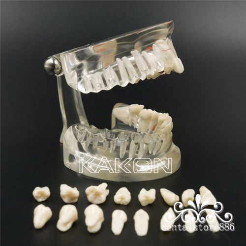 1 x Removable Teeth New Dental Study Teaching Tooth Model Disease Tooth Model