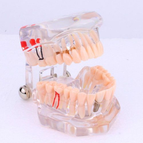 Yosoo Dental Study Teaching Teeth Model Adult Typodont Model Removable Tooth