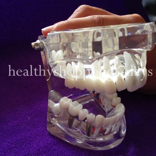 Sale 1 pc dental teeth study model classic implant model with restoration for sale