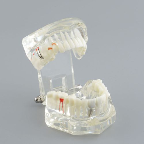Dental Implant Disease Teeth Model Study Analysis Extrusion Model Detachable