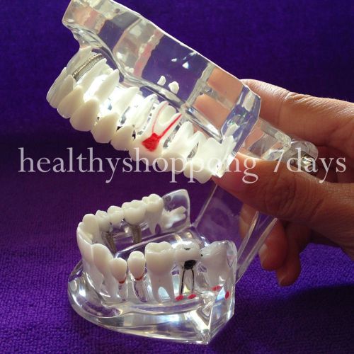 Hot dental implant disease teeth model with restoration &amp; bridge tooth study for sale