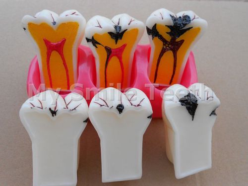 4:1 Size Dental Caries Removable Teeth Tooth Model Learn Study Model 1 Piece