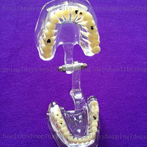 HOT!Dental pathology Study Analysis Demonstration Teeth Model with Restoration