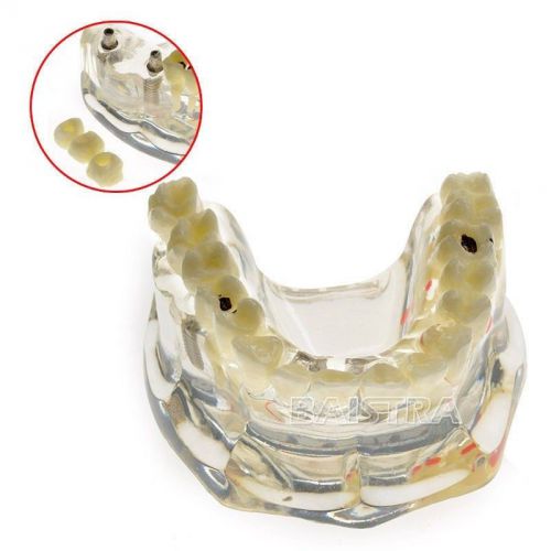 New 1 Piece Dental Dentist Teeth Study Implant Model Bridge &amp; Caries #2006