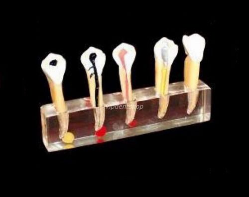 1*XINGXING tooth 5-Stage Models for Endodontic Treatment Demonstration 4007 CE