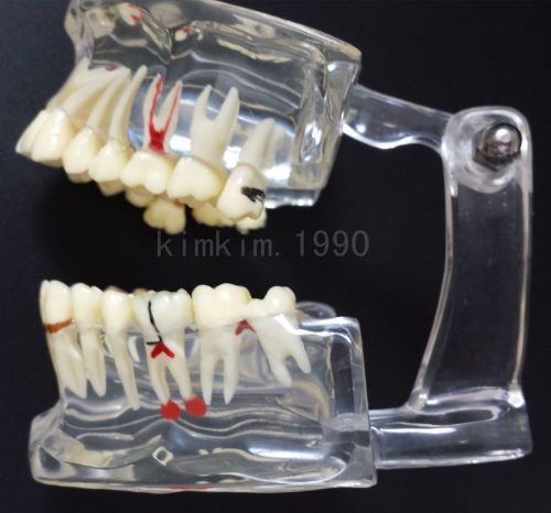 Timelimit SALE Dental teeth model for Oral Pathology teaching education