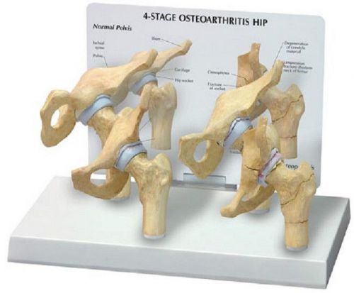 Anatomical Degenerative Bone Diseases Of The Hip Model
