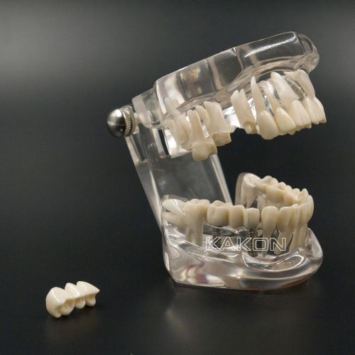 HOT 2 PCS Implant Typodont Model Dental Teeth Study Model Restoration removable
