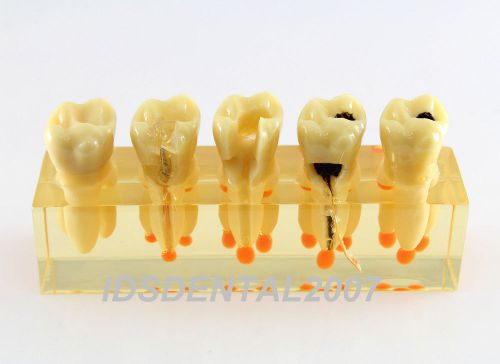 Dental Dentist Endo Endodontic Demonstration Model Flaw Clearance