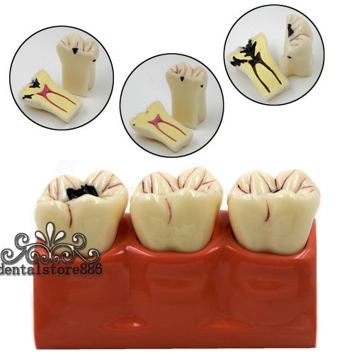 Dental Patient Education Teeth Model Caries Treatment Study Model 4:1