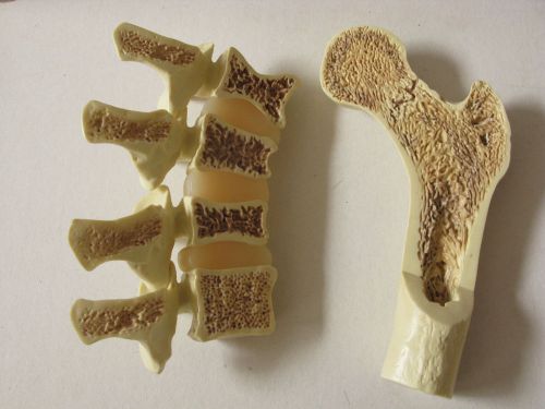 Medical Model Shows Vertebrae and Bone Different Stages Osteoporosis Spine