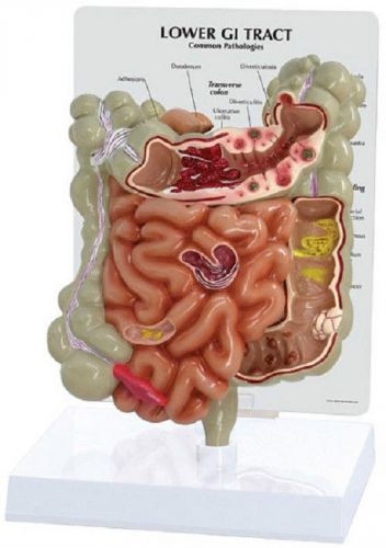 NEW Anatomical  GI Tract Pathologies Intestine Model