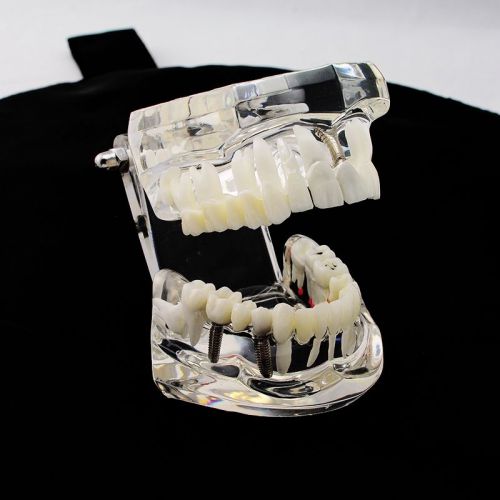Dental Implant Disease Teeth Model with Restoration &amp; Bridge sale 1000pieces