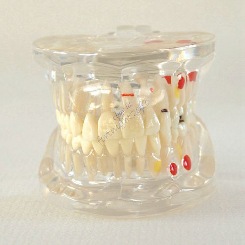 Hs dental restoration &amp; pathology analysis demonstration educateeth clear model for sale