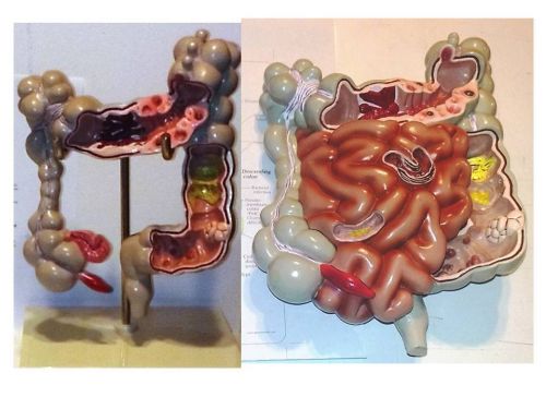 Colon Anatomy Model With Pathologies And LOWER GI TRACT