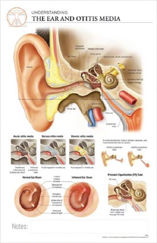 11 x 17 Post-It Disease Chart: The Ear &amp; OTITIS MEDIA